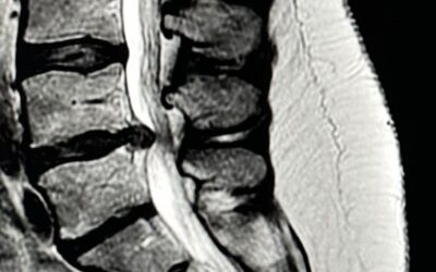 Tratamiento quirúrgico de la hernia discal lumbar: microdiscectomía vs. discectomía endoscópica