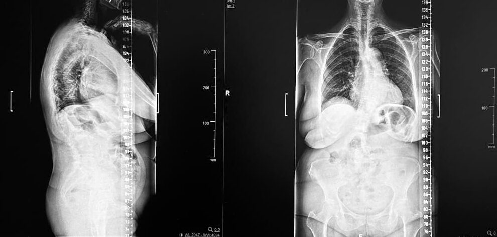 Escoliosis Lumbar del Adulto y Tratamiento Quirúrgico con Guías 3D