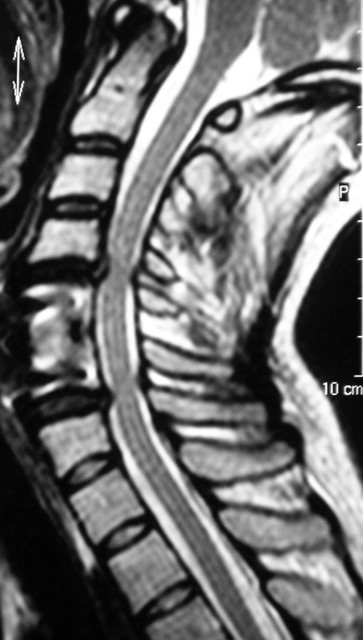 Mielopatía cervical