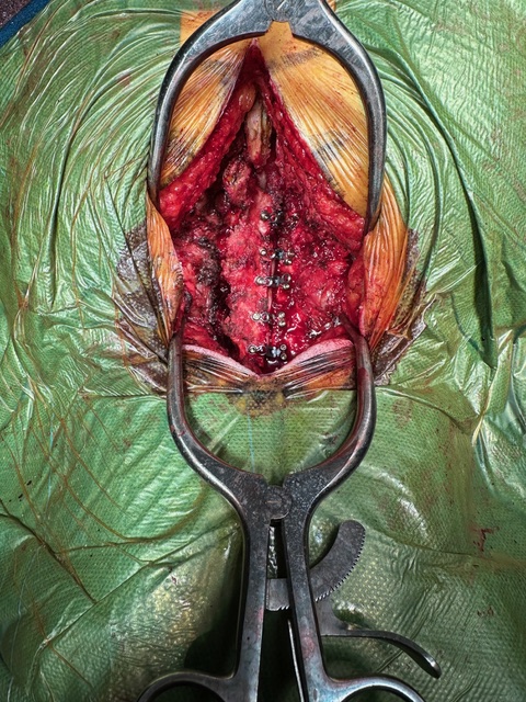 cirugía de mielopatía Cervical Valencia