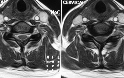 Mielopatía Cervical por Cervicoartrosis (MEC)