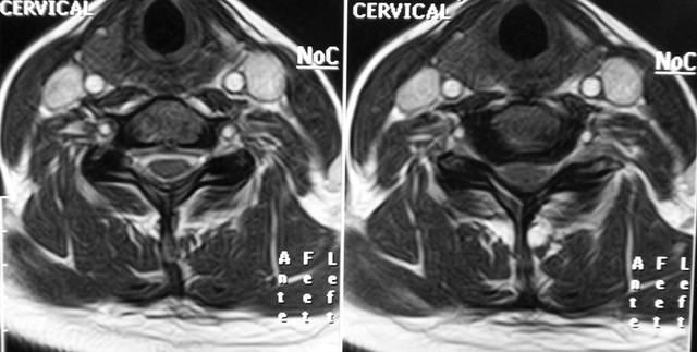 Mielopatía Cervical por Cervicoartrosis (MEC)