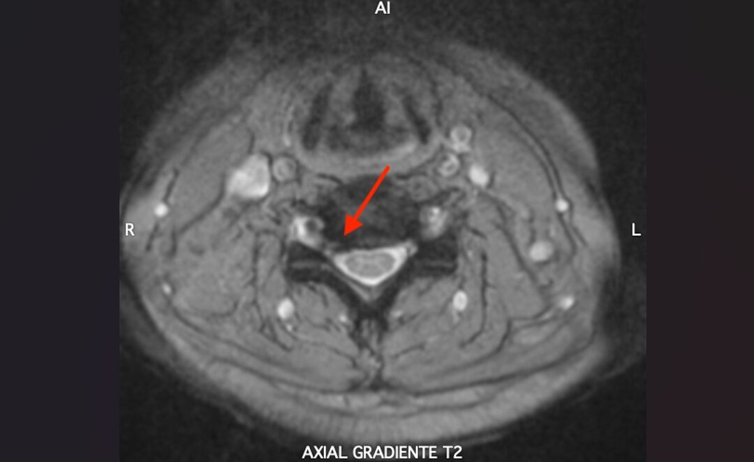 FORAMINOTOMÍA CERVICAL ENDOSCÓPICA EN EL TRATAMIENTO DE LA RADICULOPATÍA CERVICAL: ¿UNA ALTERNATIVA REAL A LA DISCECTOMÍA CERVICAL ANTERIOR Y ARTRODESIS?