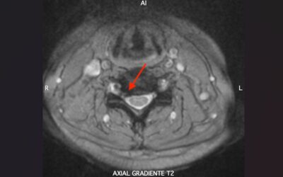 FORAMINOTOMÍA CERVICAL ENDOSCÓPICA EN EL TRATAMIENTO DE LA RADICULOPATÍA CERVICAL: ¿UNA ALTERNATIVA REAL A LA DISCECTOMÍA CERVICAL ANTERIOR Y ARTRODESIS?