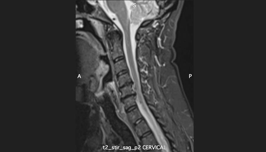 t2_stir_sag_p2 CERVICAL