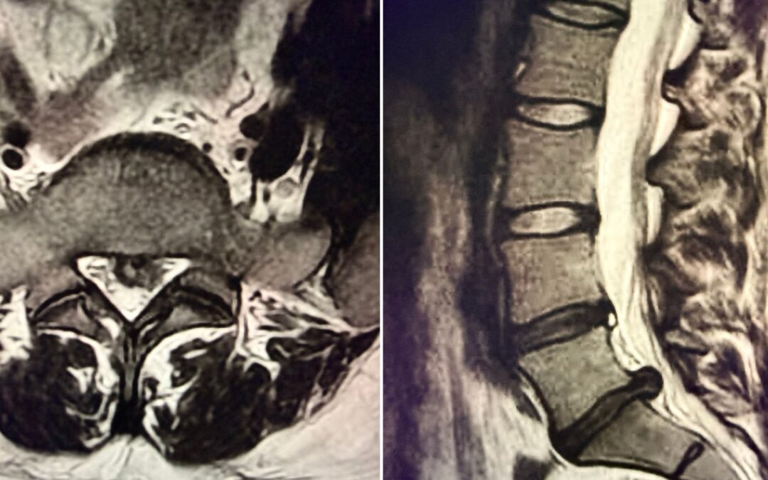 Hernia discal lumbar: ¿microdiscectomía o endoscopia?