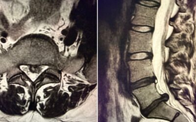 Hernia discal lumbar: ¿microdiscectomía o endoscopia?